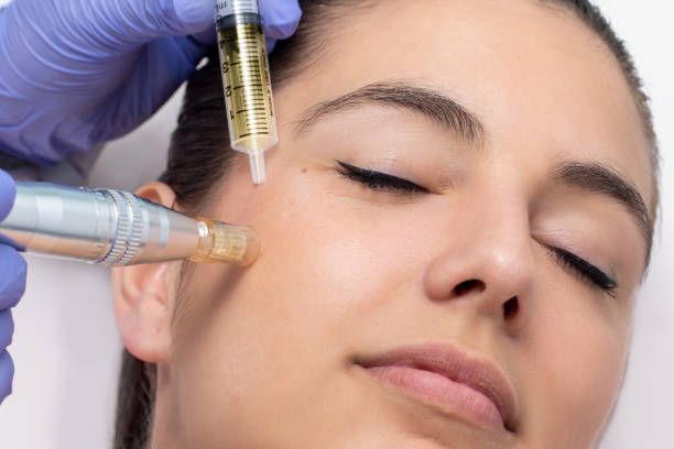 Een vrouw krijgt een microdermabrasiebehandeling op haar gezicht.