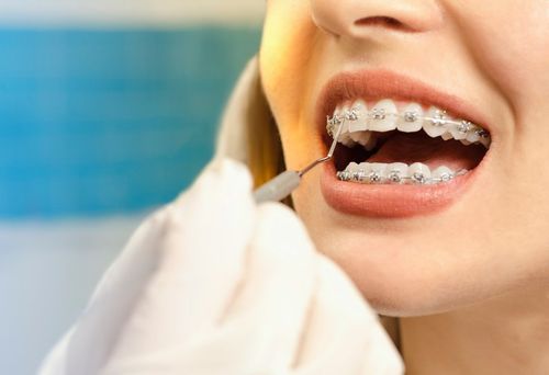 Apparecchio denti