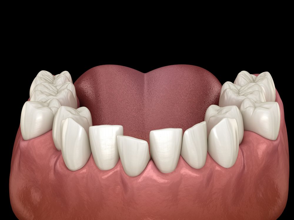 Dental model showing teeth with a gap, tongue in the background. Pink gums and black background.