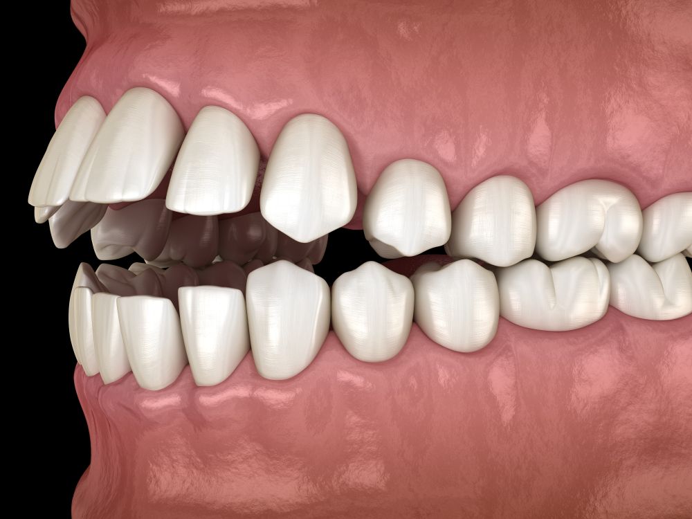 Side view of teeth showing severe overbite and crowding.