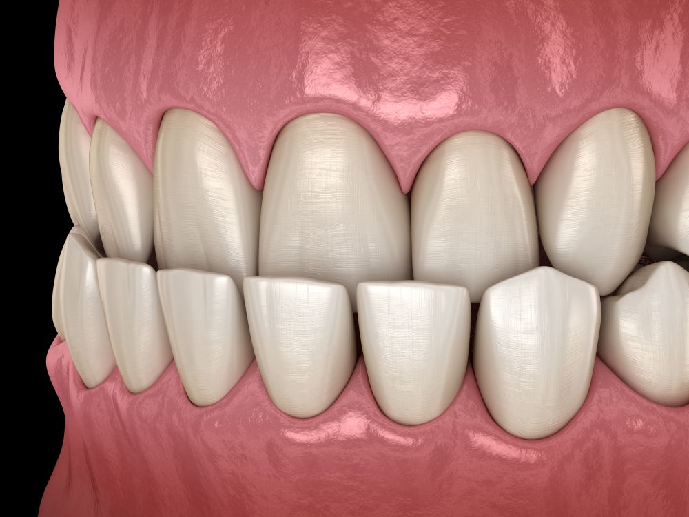 Close-up of human teeth, showing healthy gums and slightly uneven teeth against a black background.