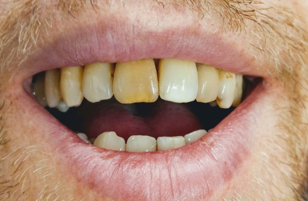 A close-up of a person's open mouth showing yellowed and discolored front teeth.