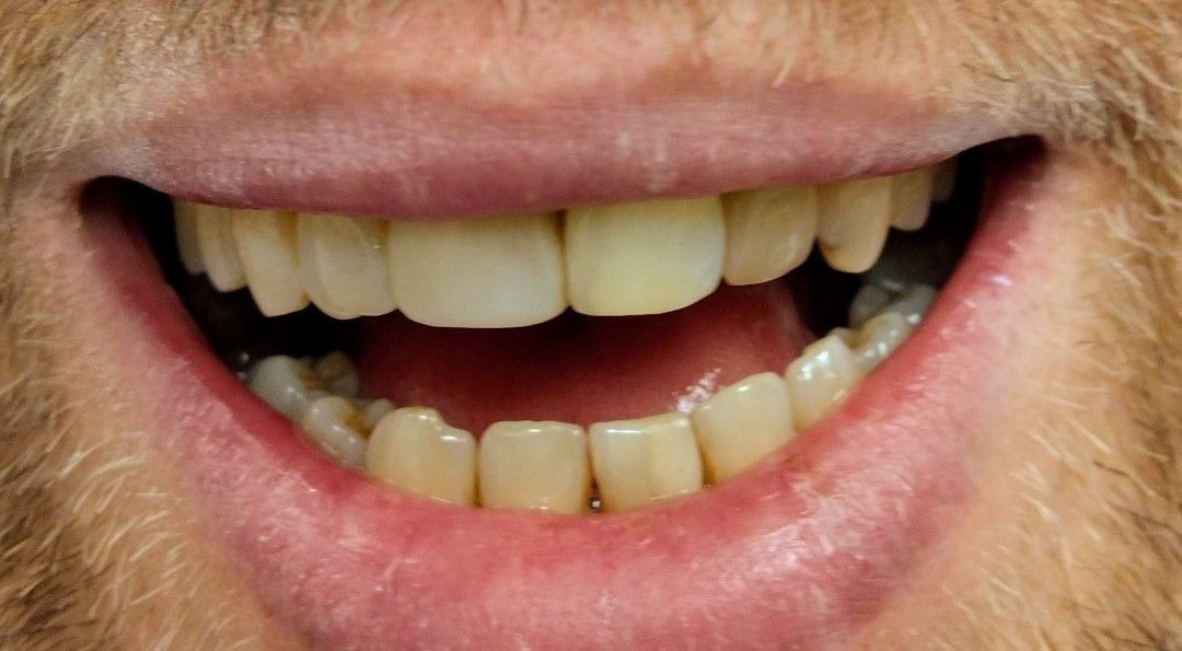 A close-up view of a person’s lower face, showing a wide, smiling mouth with visible teeth.