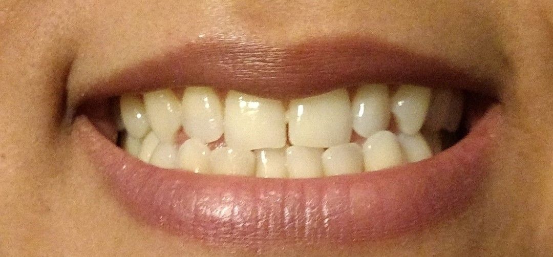 A close-up view of a person’s mouth showing straight, white teeth in a gentle smile.