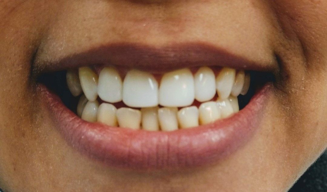 Close-up of a person smiling, showing straight, white teeth and healthy gums.