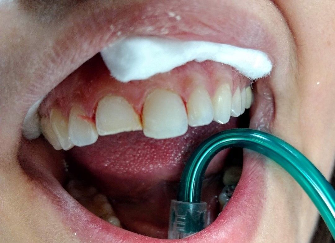 A close-up of teeth during a dental procedure, with a cotton roll on the gums and a suction tube inserted in the mouth.