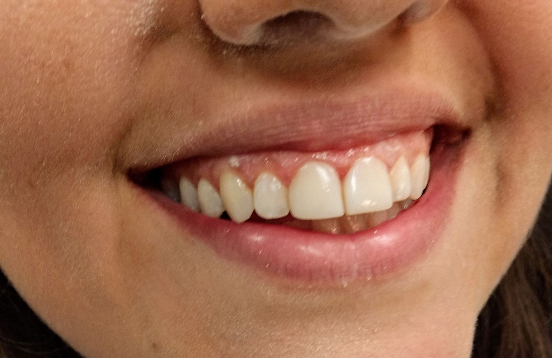 Close-up of a person smiling, showing their teeth and gums.