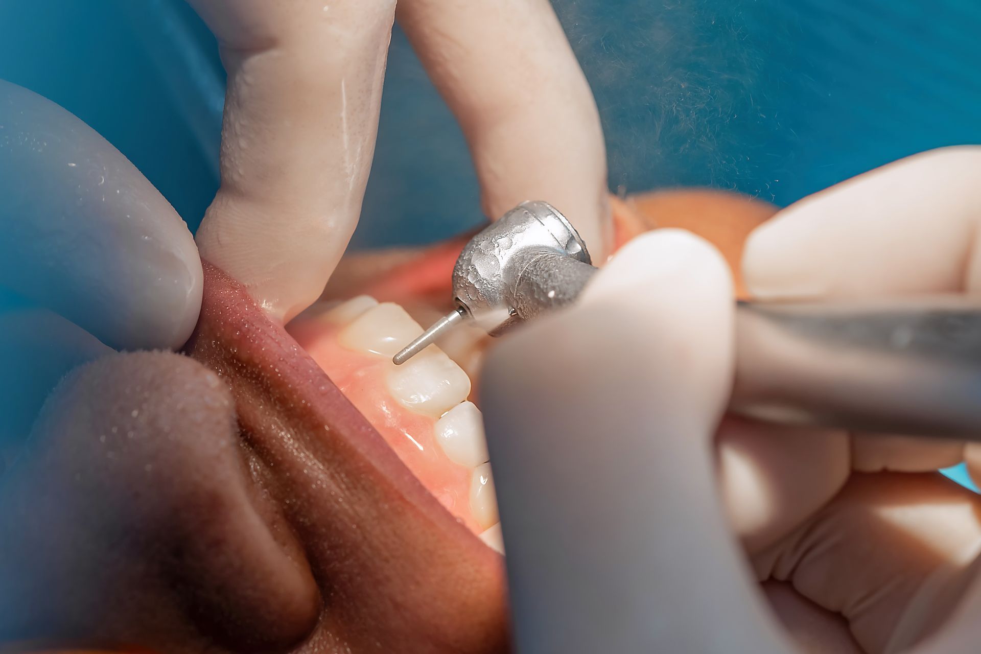 Close-up of a tooth being prepared with a dental drill