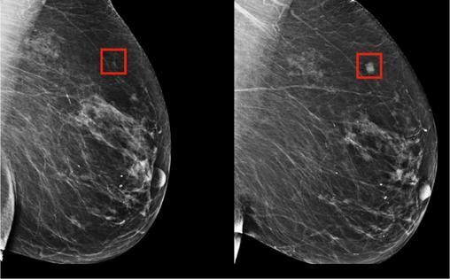 Duas radiografias da mama de uma mulher mostrando diferentes estágios do câncer de mama.