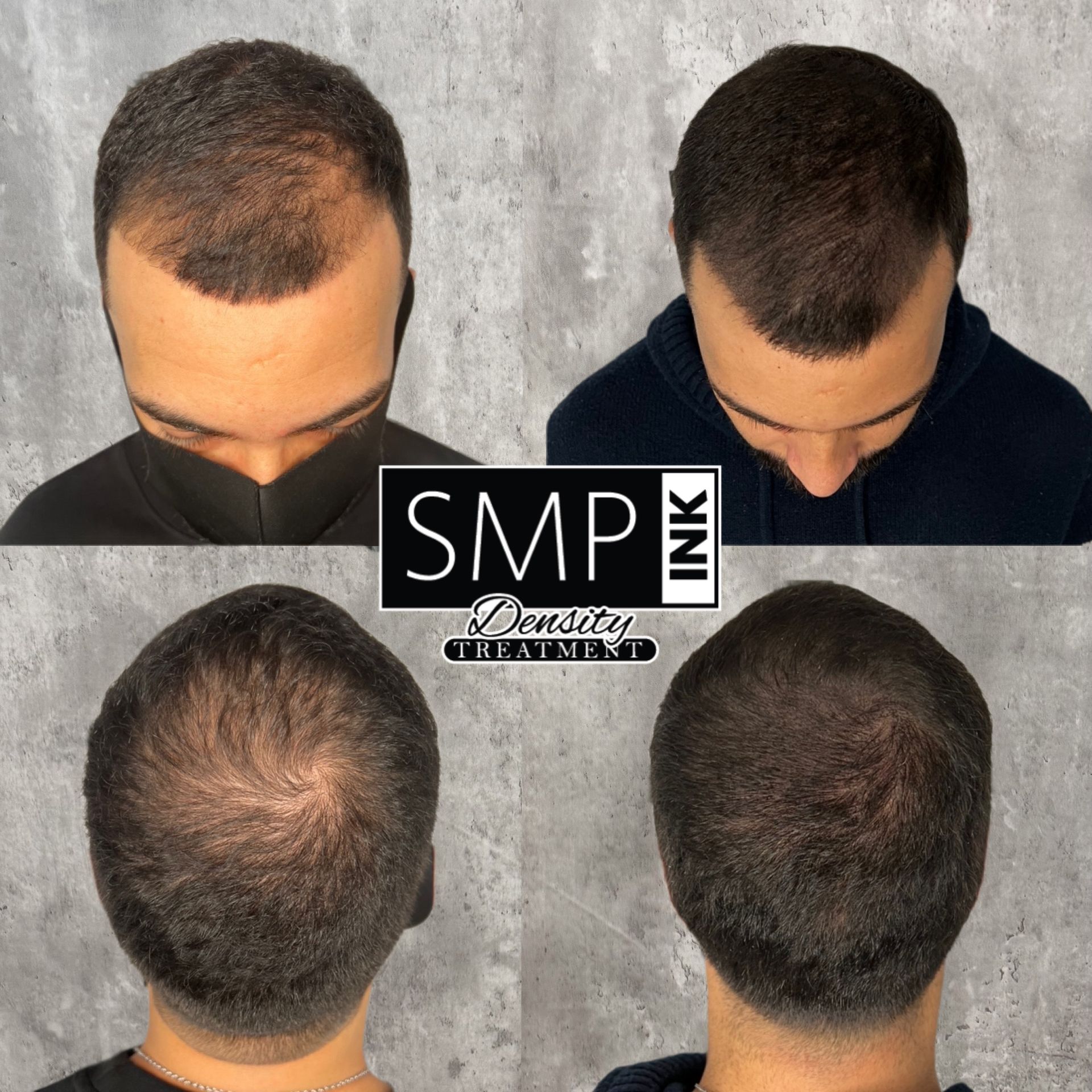 smp crown before and after