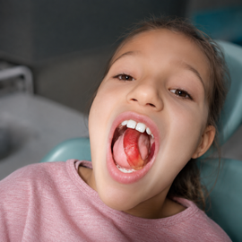 Child with mouth open wide on a dental chair, showing tongue and teeth in a close-up.