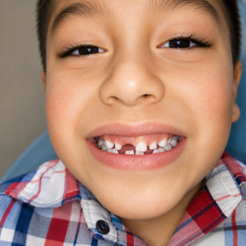 Close-up of a smiling child showing a missing front tooth, wearing a red-and-blue plaid shirt.