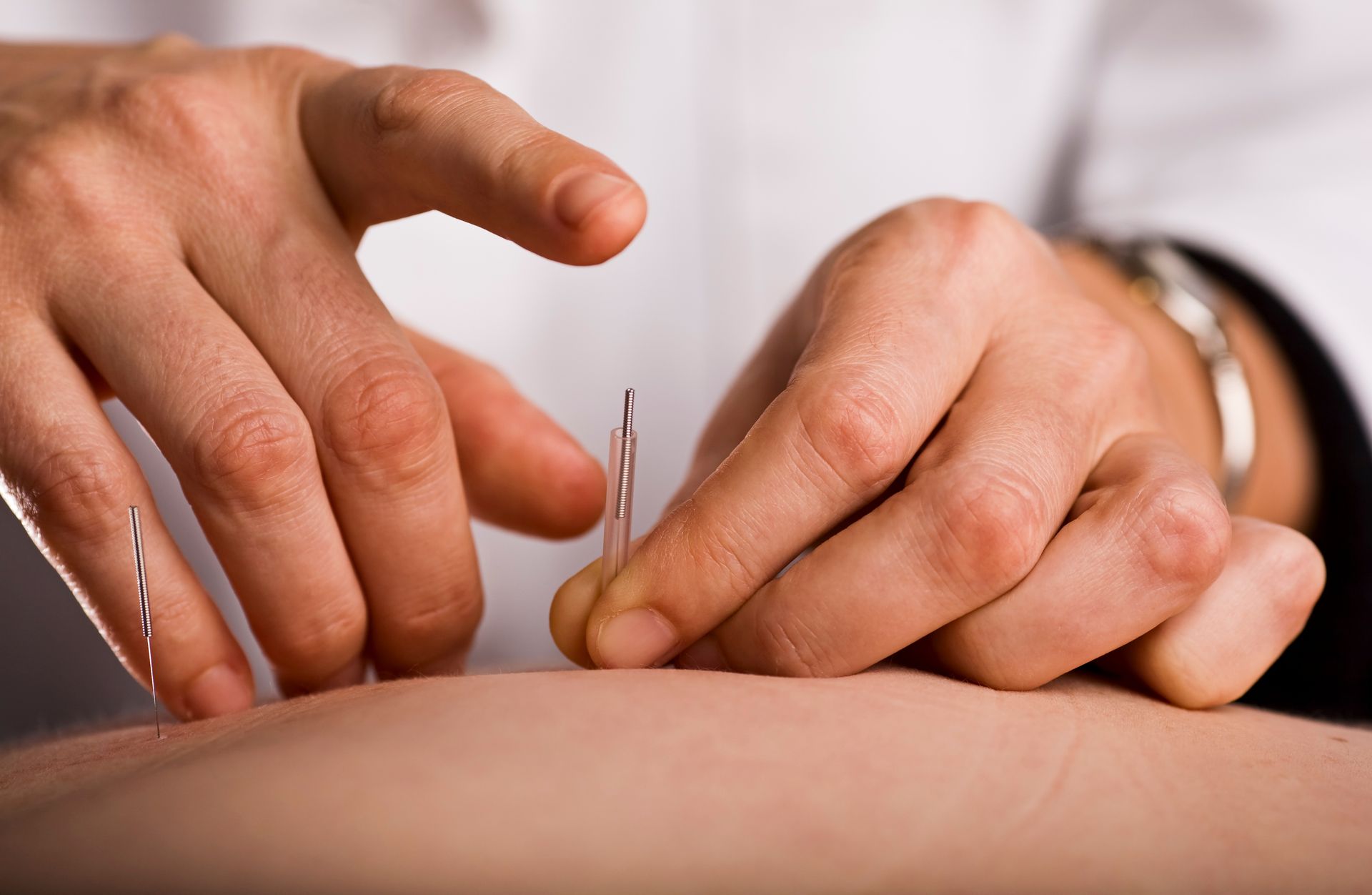 Hands inserting acupuncture needles into a person's skin close-up