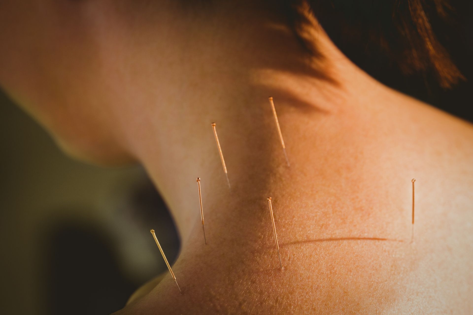 Close-up of a shoulder and neck with acupuncture needles inserted in warm light