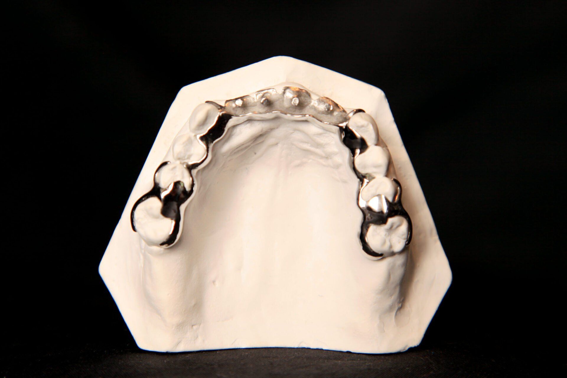 Modèle de prothèse dentaire partielle sur un moule blanc, avec des dents métalliques argentées.