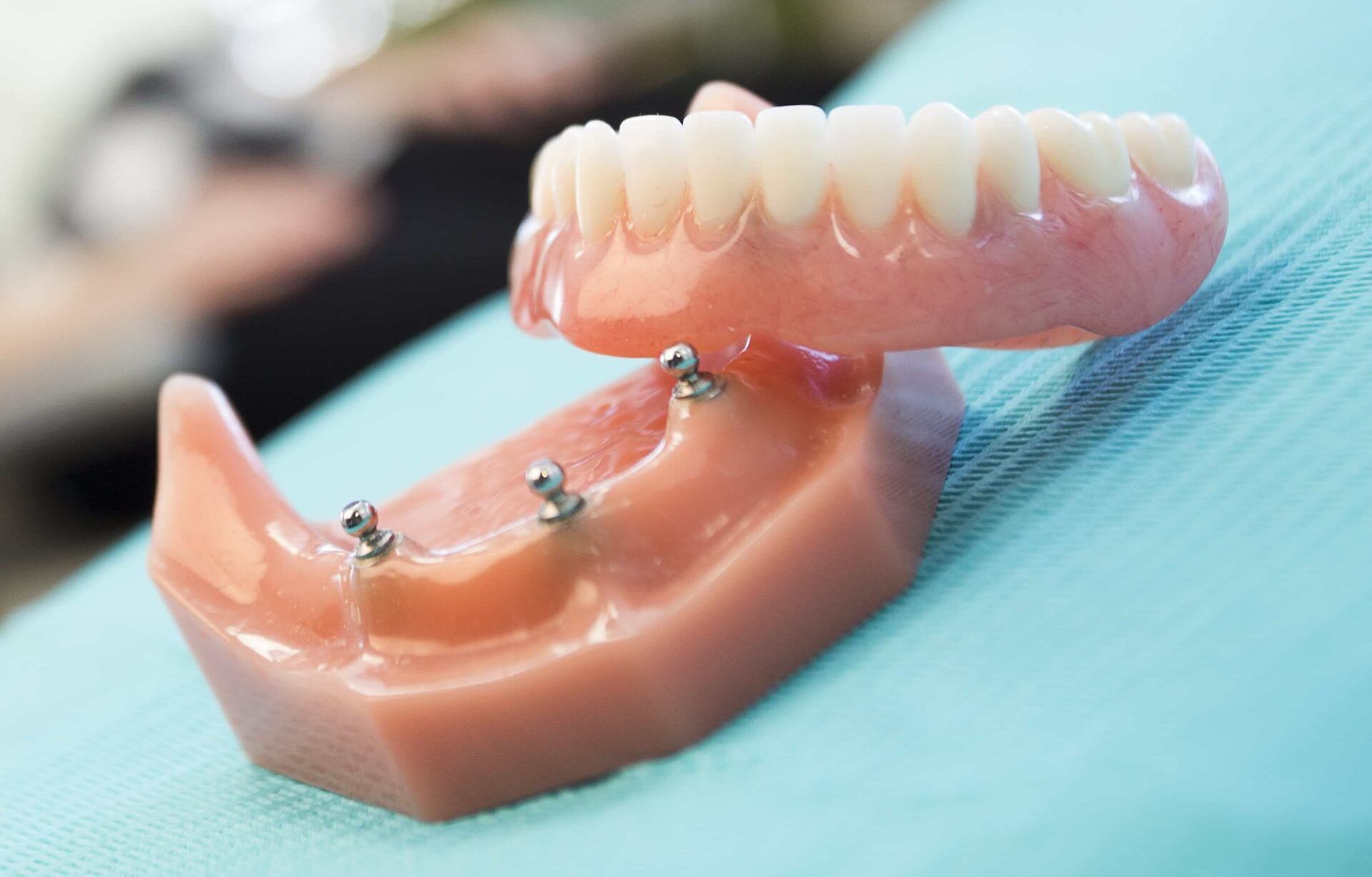 Prothèse dentaire supérieure avec attaches métalliques, sur une surface bleue.