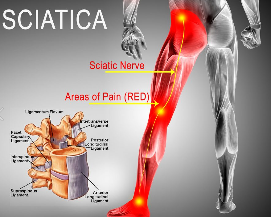 sciatica-pain