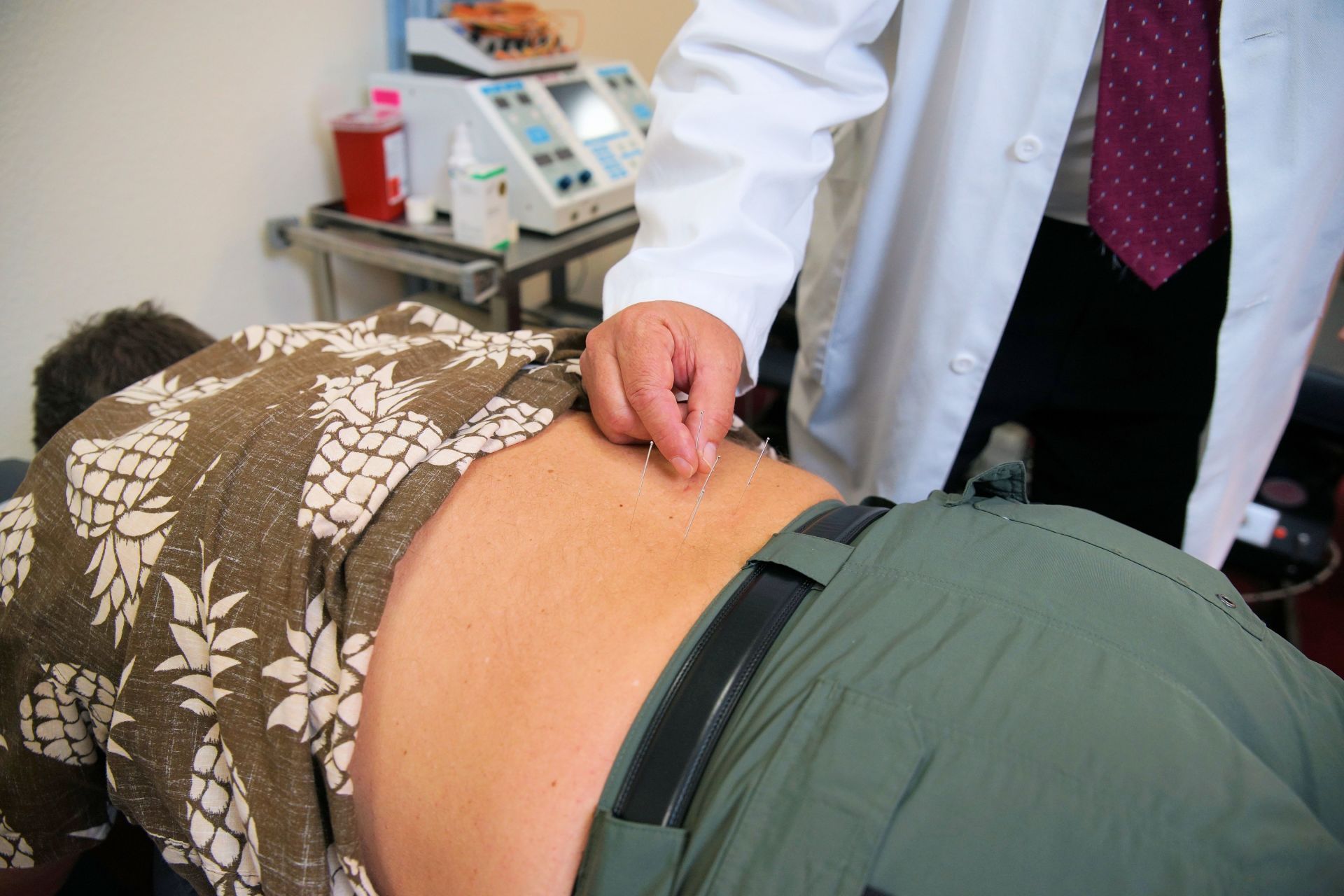 acupuncture-technique