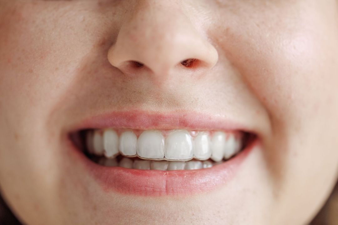Apparecchio invisibile per denti