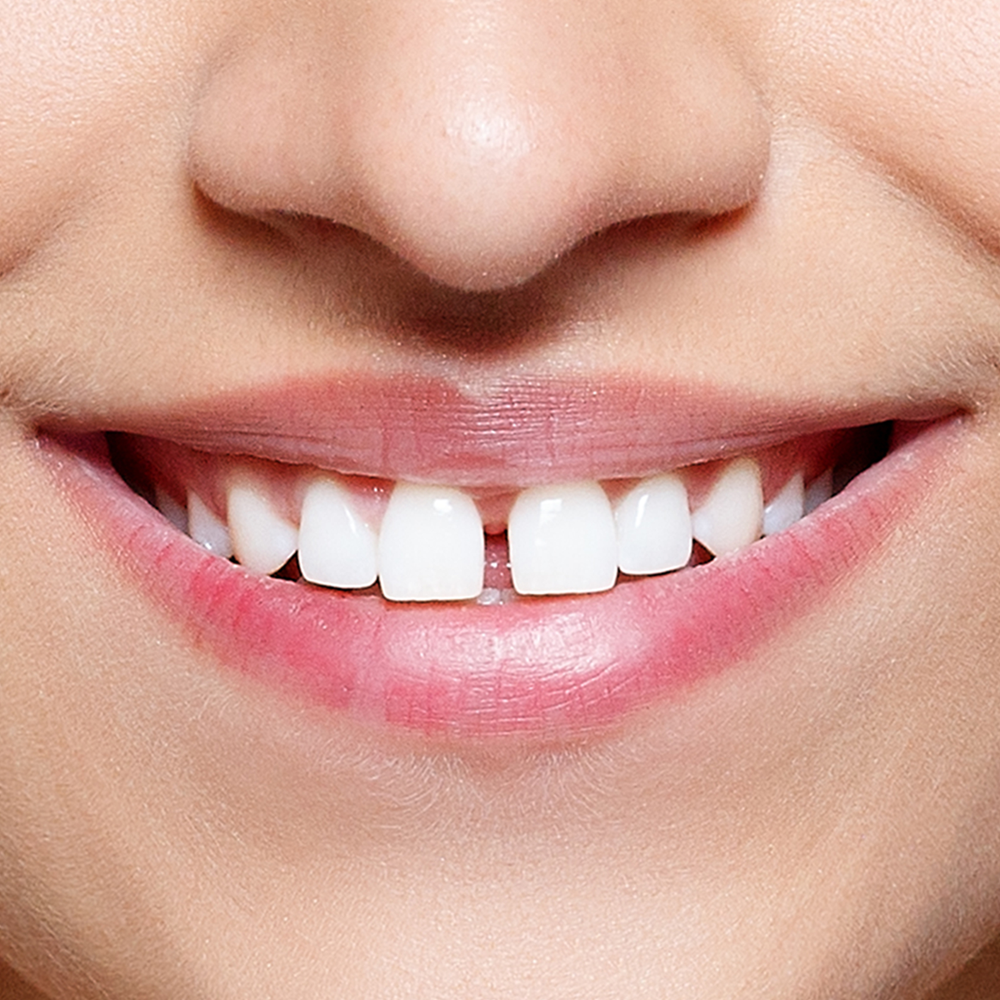 A close up of a woman 's smile with a missing tooth.