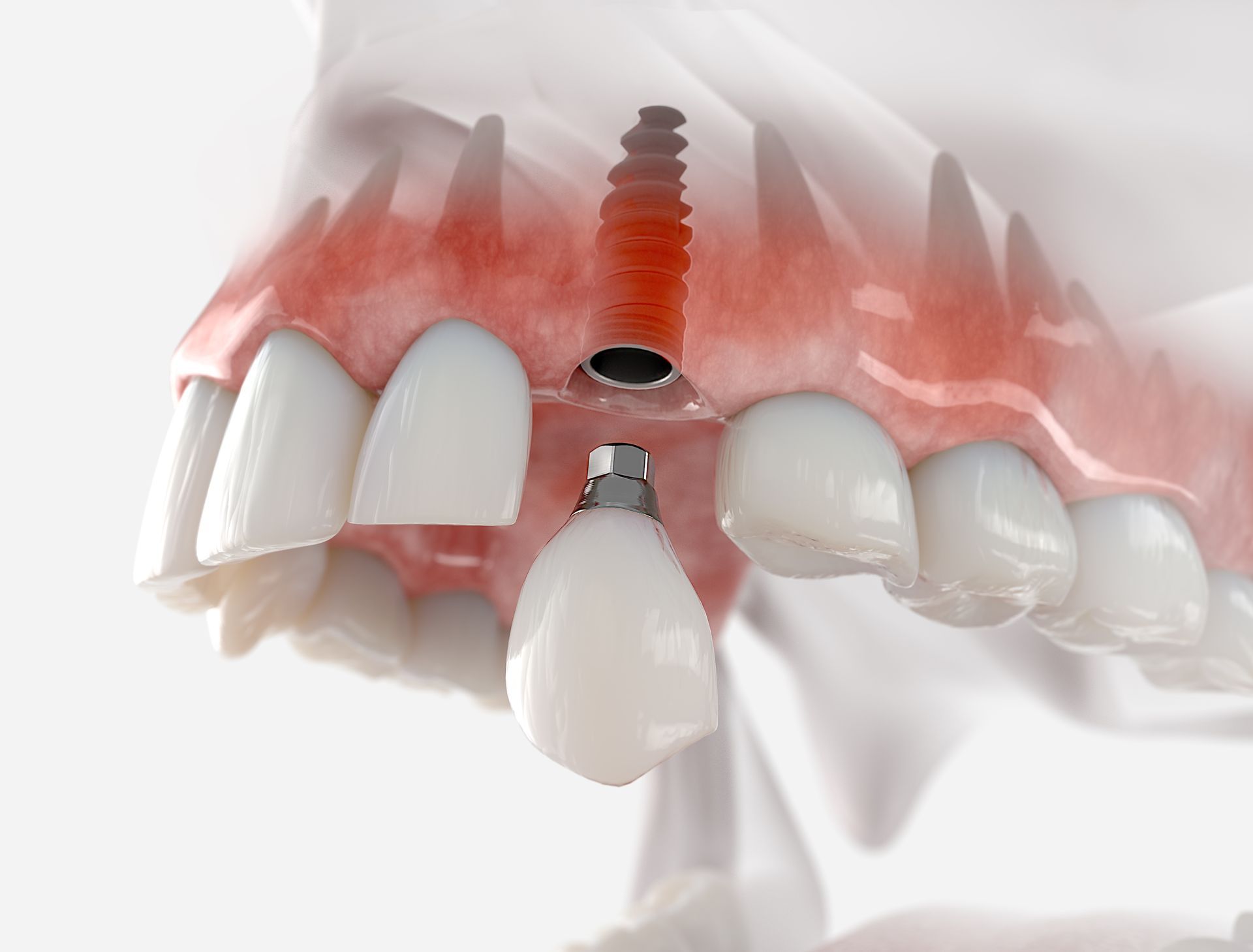 A model of a dental implant in a person 's mouth.