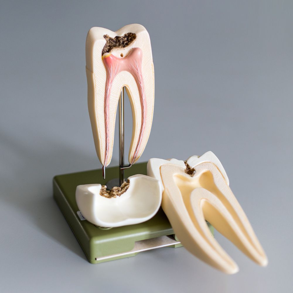 A model of a tooth with a hole in it