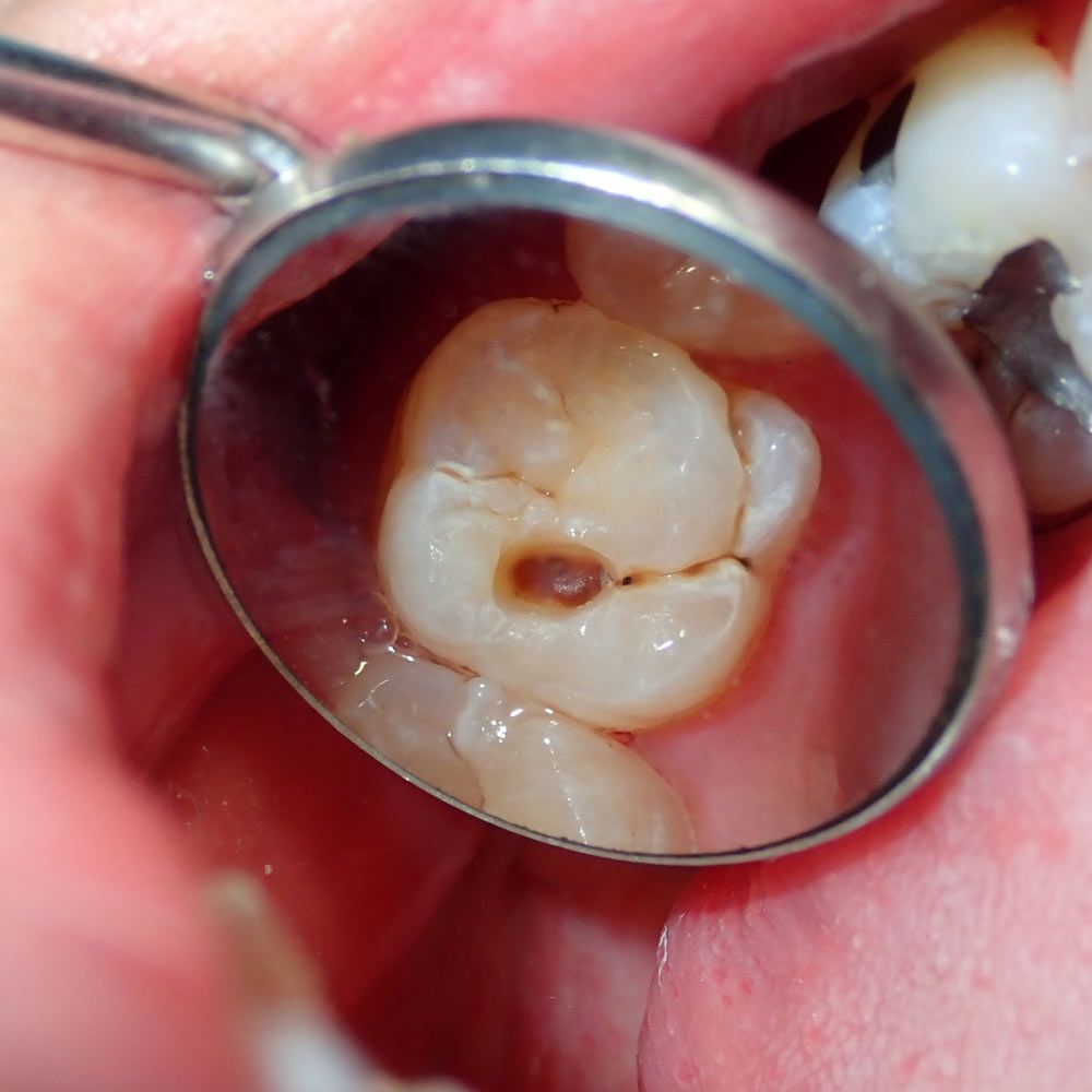A close up of a tooth with a hole in it