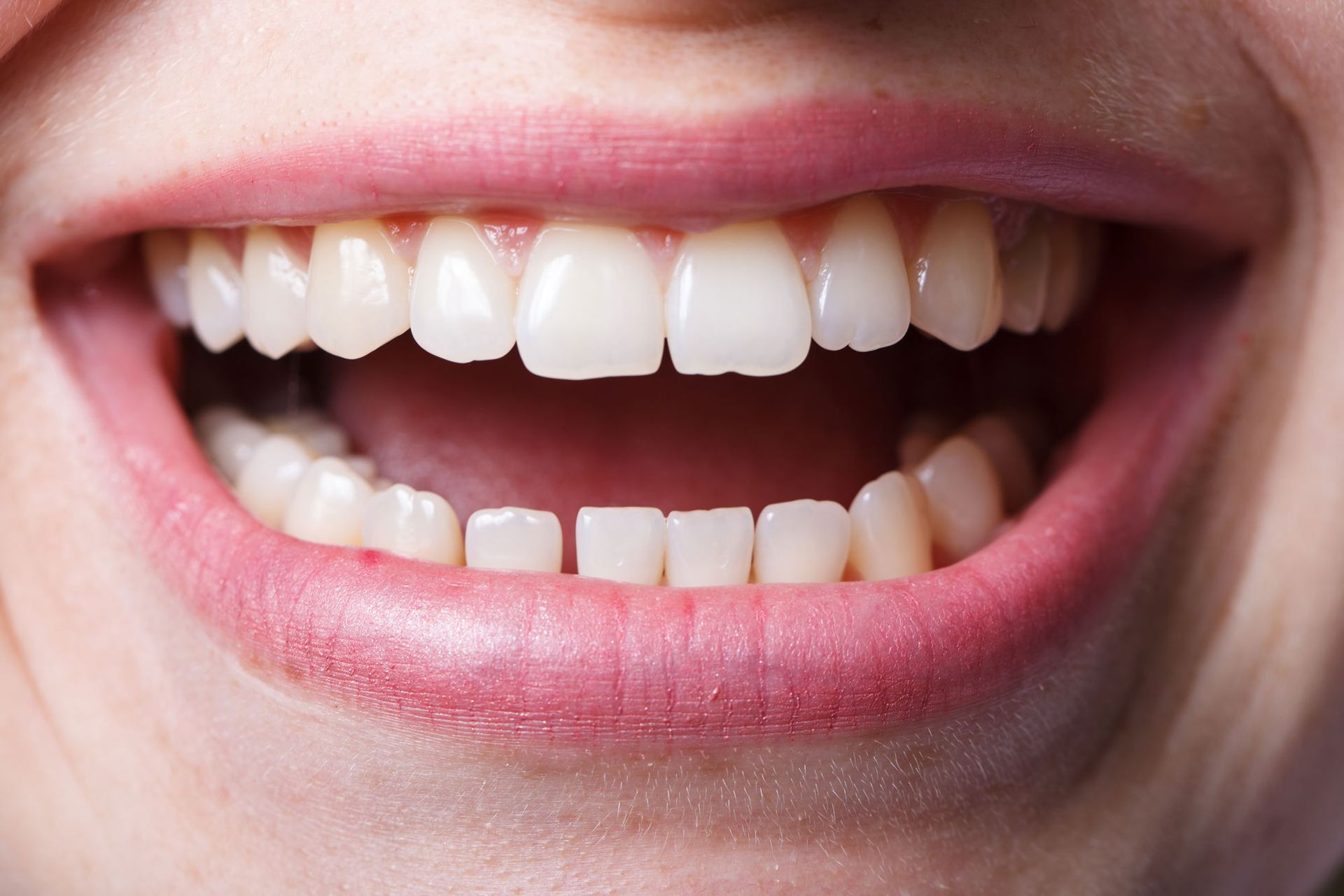 A close up of a woman 's teeth with her mouth open.