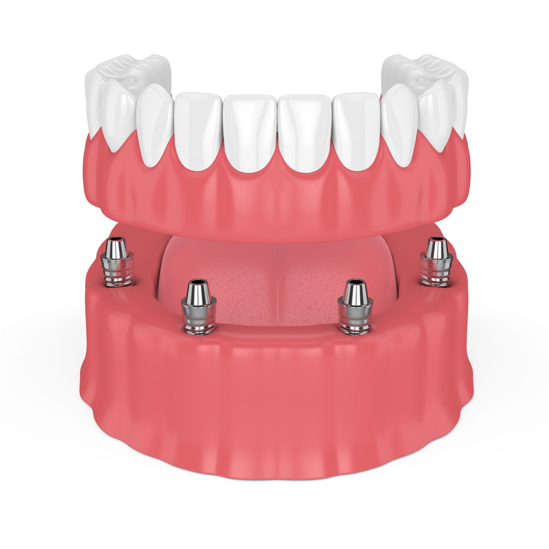 A 3d model of a full denture with dental implants.