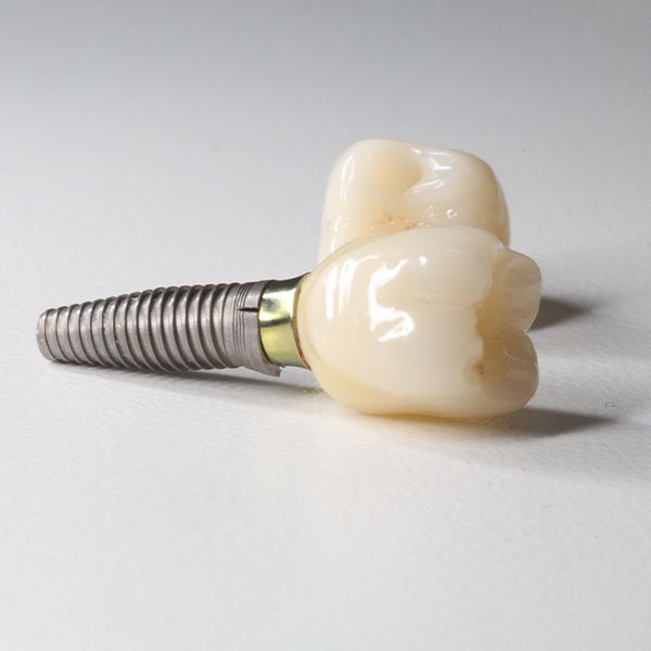 A dental implant with two teeth attached to it
