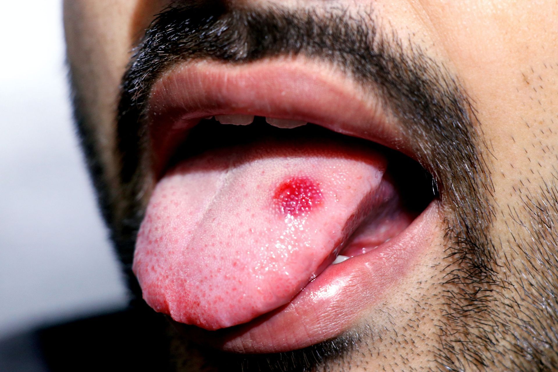 A man with a beard has a red spot on his tongue.