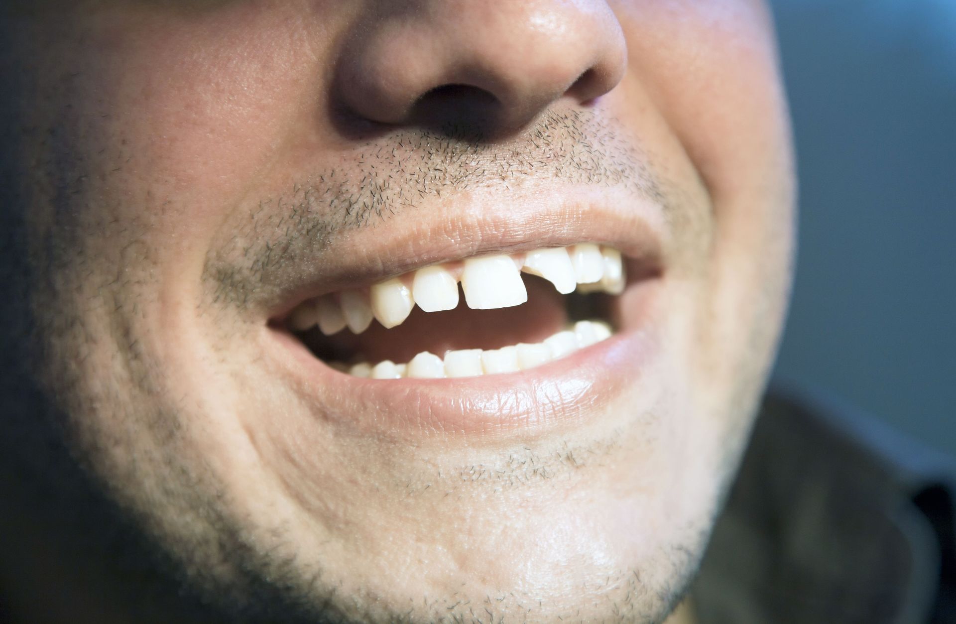 A close up of a man 's mouth with a missing tooth.
