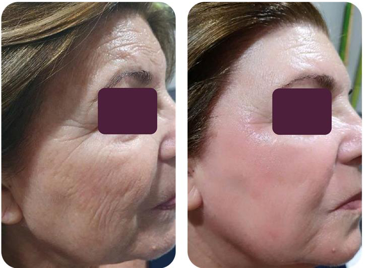 Before and after WonderTouch RF treatment showing skin tightening and wrinkle reduction 