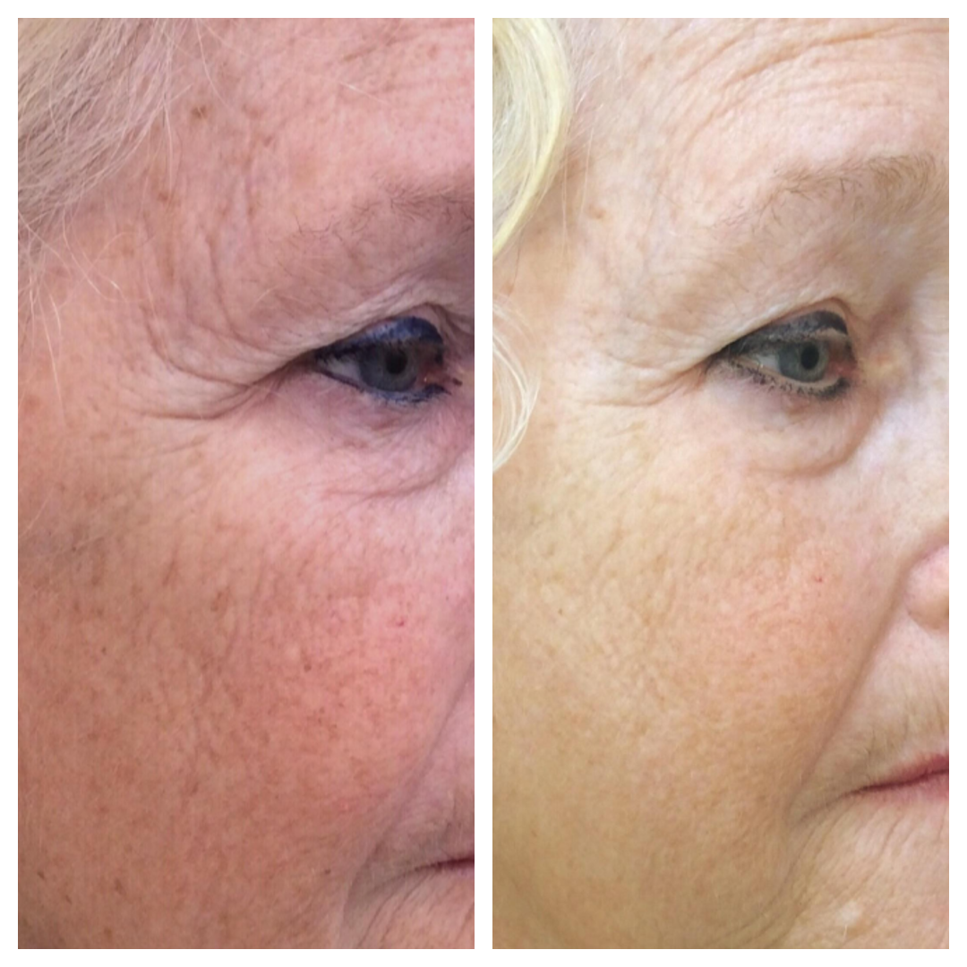 A before and after photo of an older woman 's face