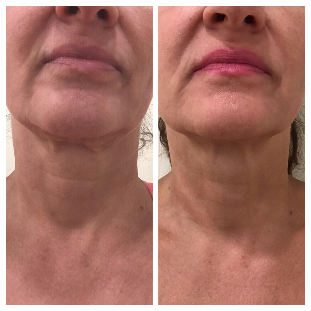 A before and after photo of a woman 's neck and face.