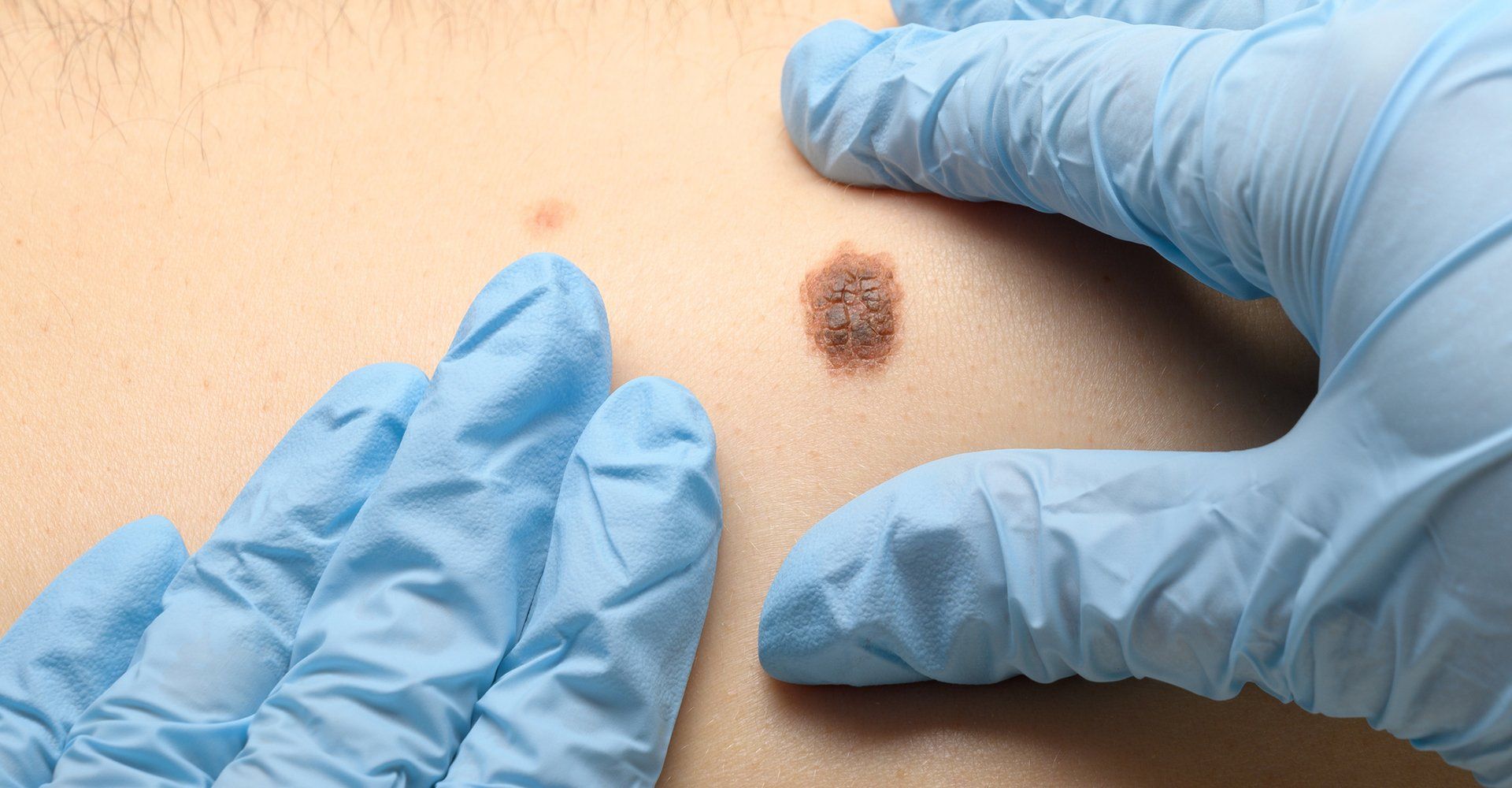Close Up Look Of Mole — Davenport, IA — William Colantoni Jr MD PC