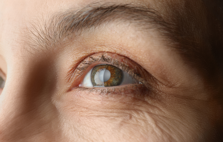 Cataracts 2 | Farallon Eye Physicians