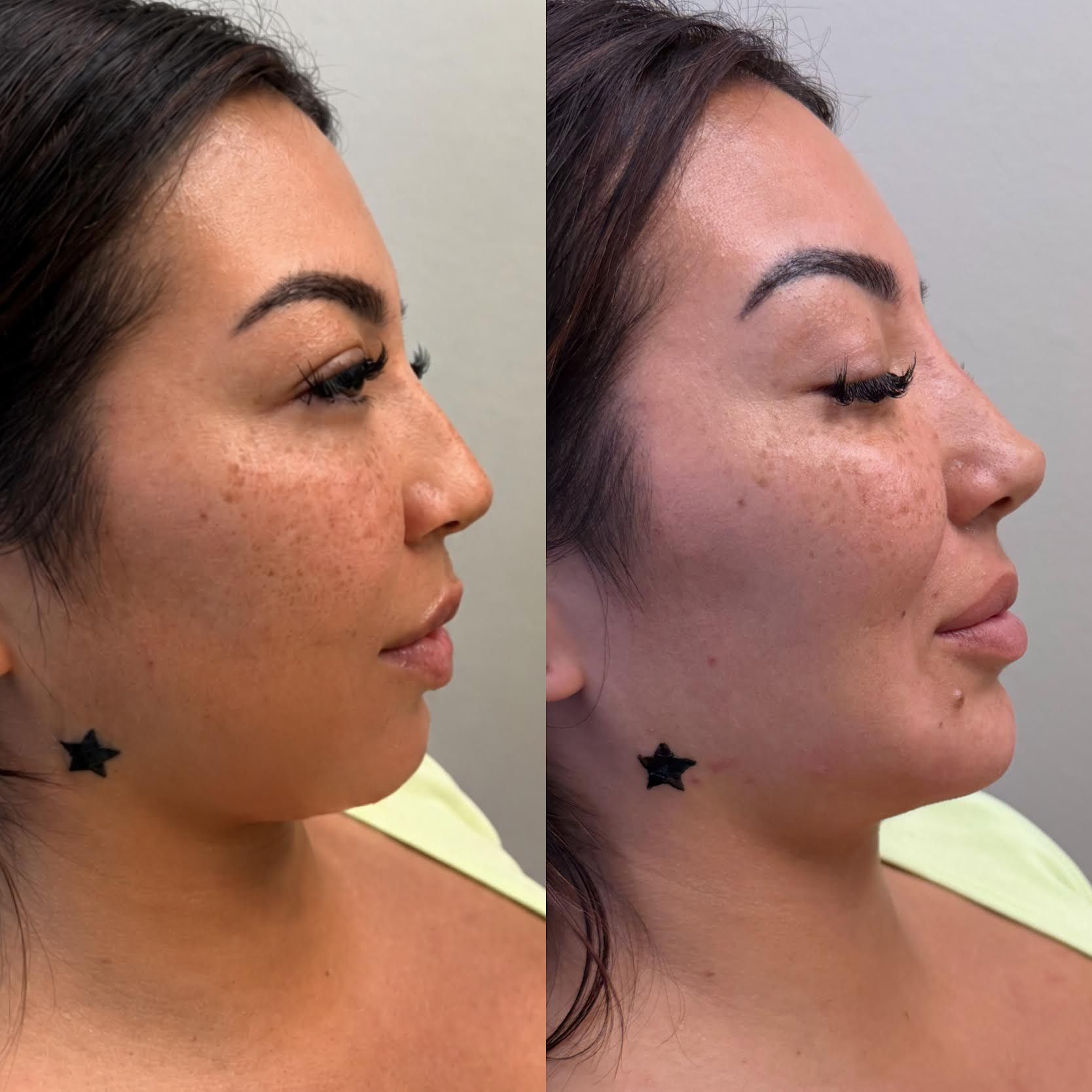 Side-by-side profile of a woman’s face before and after skin treatment, showing smoother skin on the right.