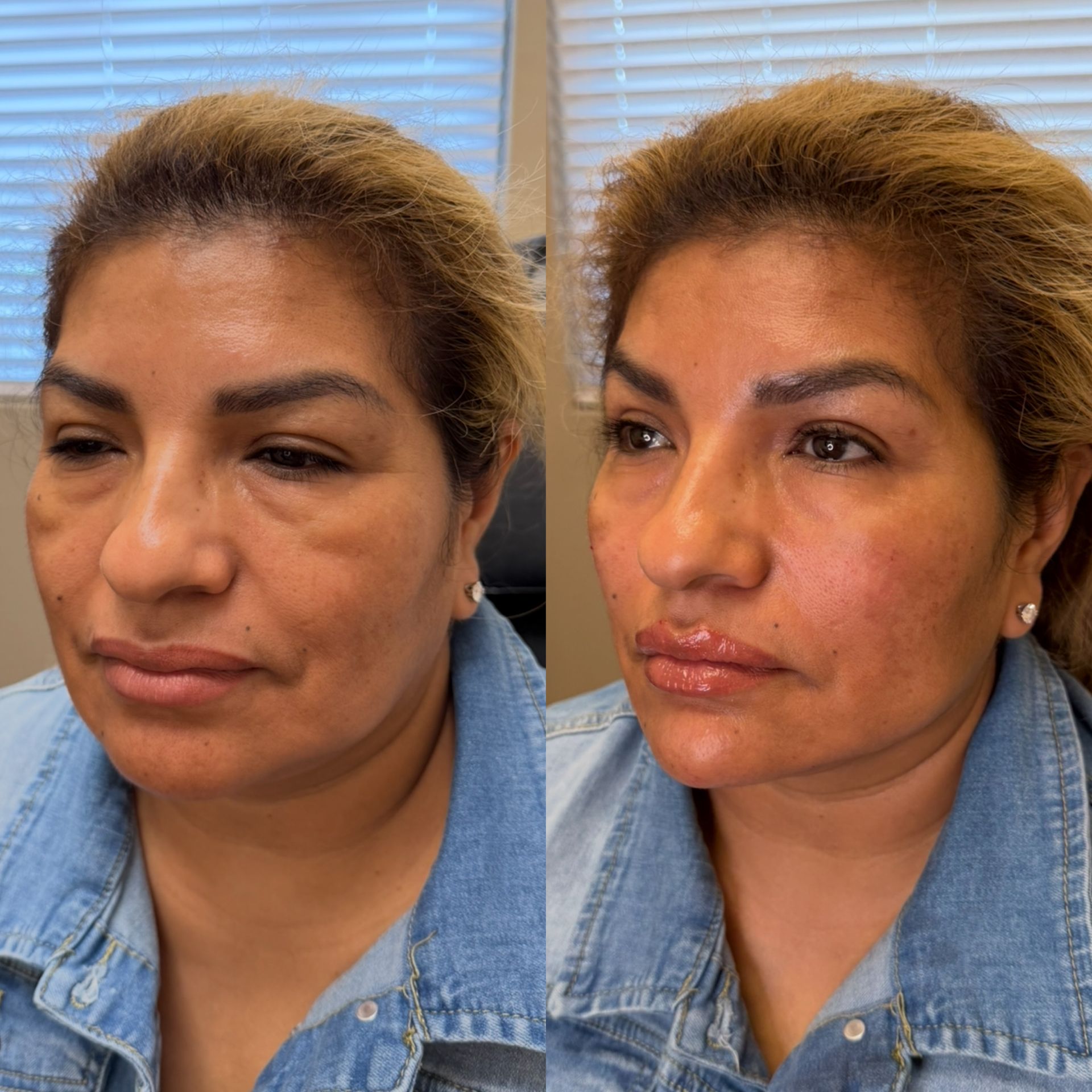 Side-by-side facial closeups of the same woman before and after treatment, with softer skin and makeup on the right