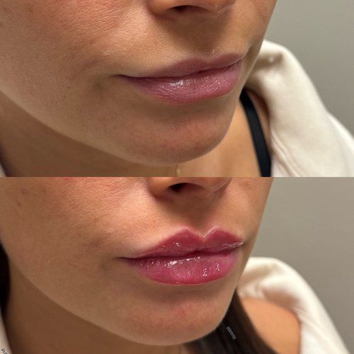 Close-up of lips before and after gloss, with the lower image showing fuller pink shine.
