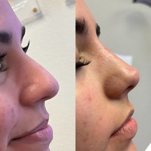 Side-by-side close-up profile of a person's nose before and after cosmetic refinement.
