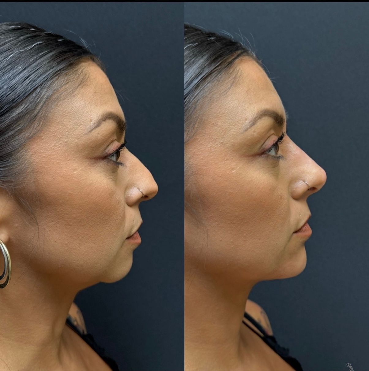 Side-by-side profile photos of a woman before and after a cosmetic change, against a dark background