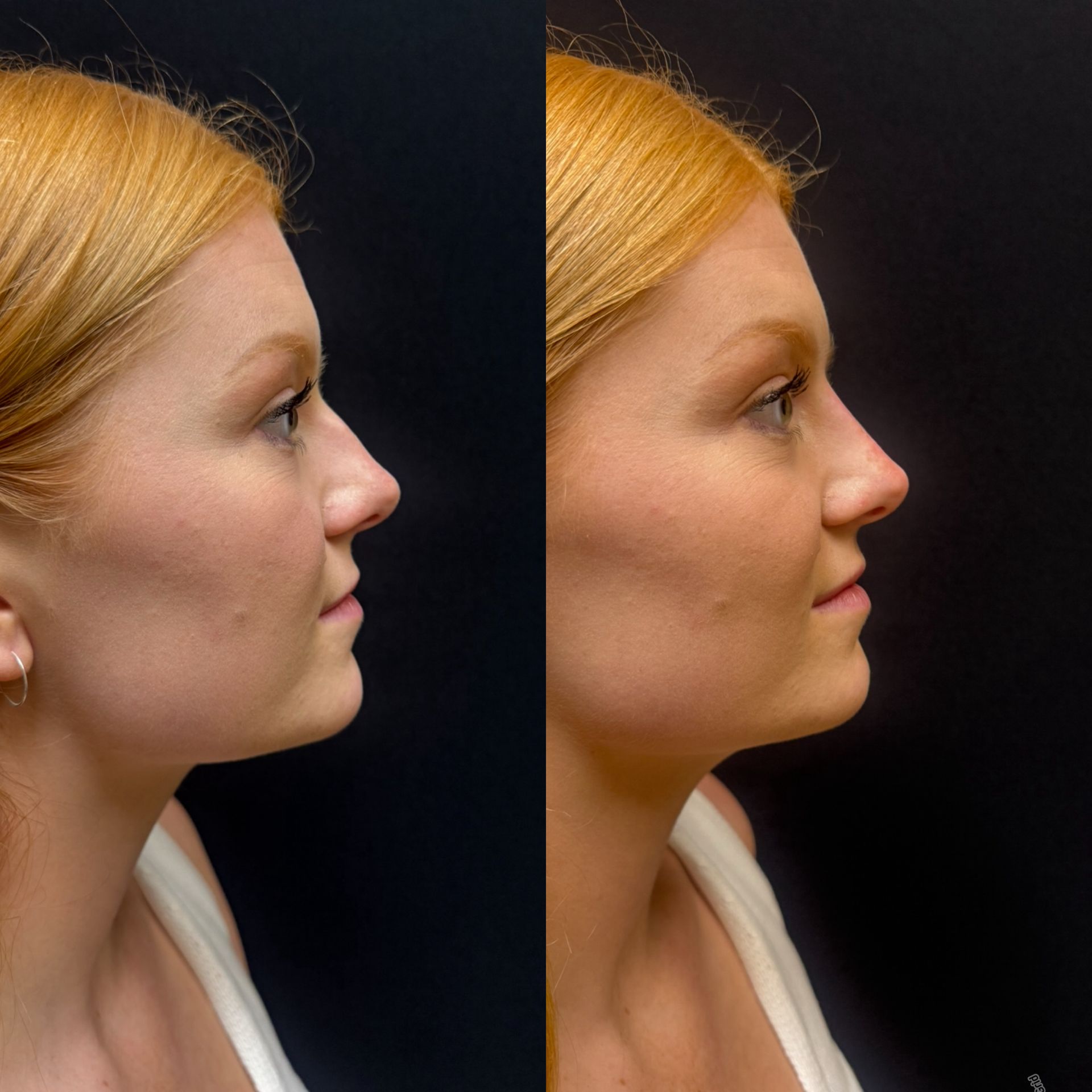 Side-by-side profile portraits of the same person, showing a before-and-after facial change against a dark background