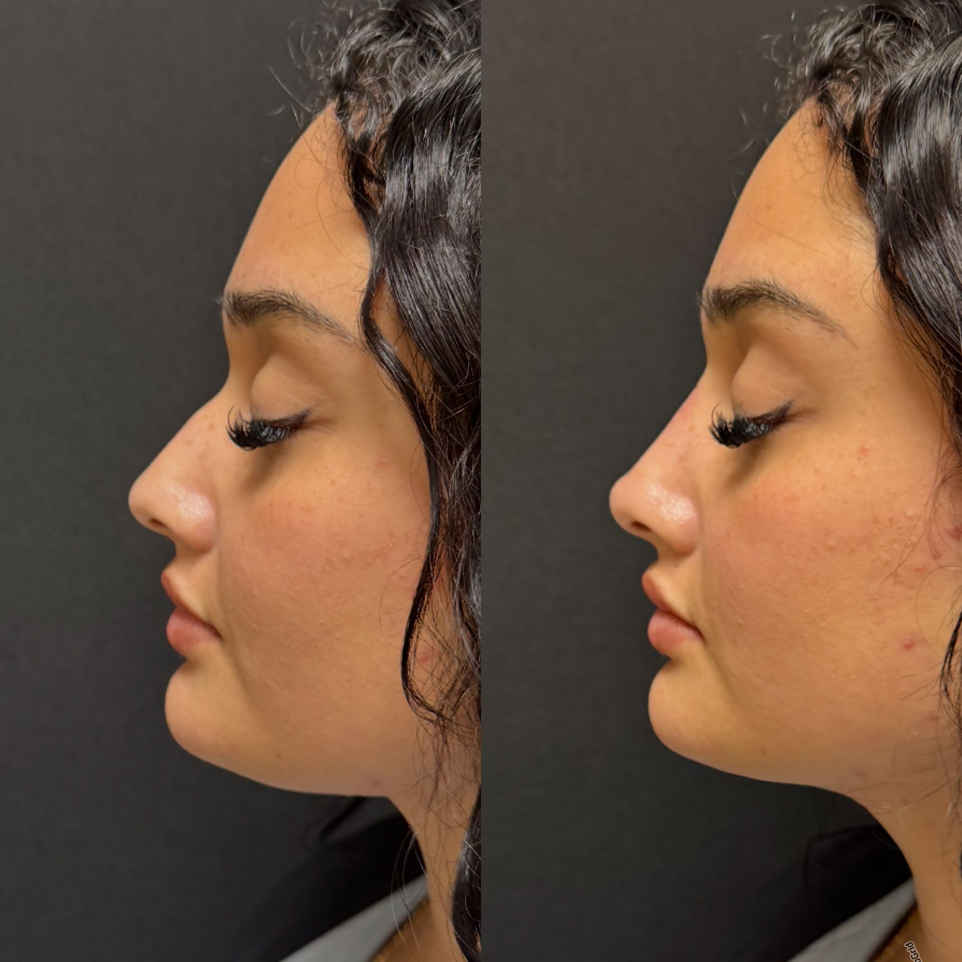 Side-by-side profile photos of a woman's face, showing before and after skin texture.