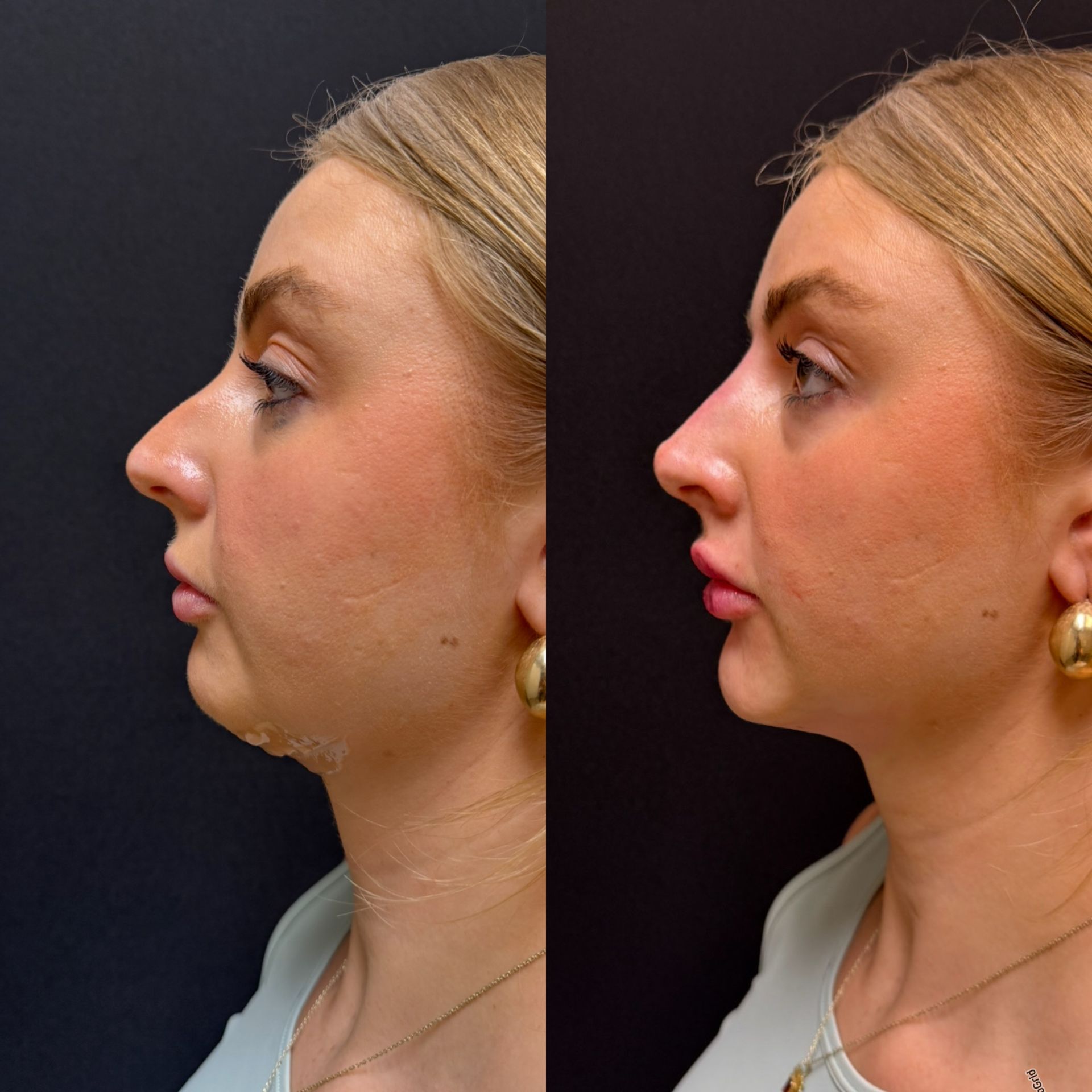 Side-by-side profile photos of a woman before and after cosmetic treatment on a dark background