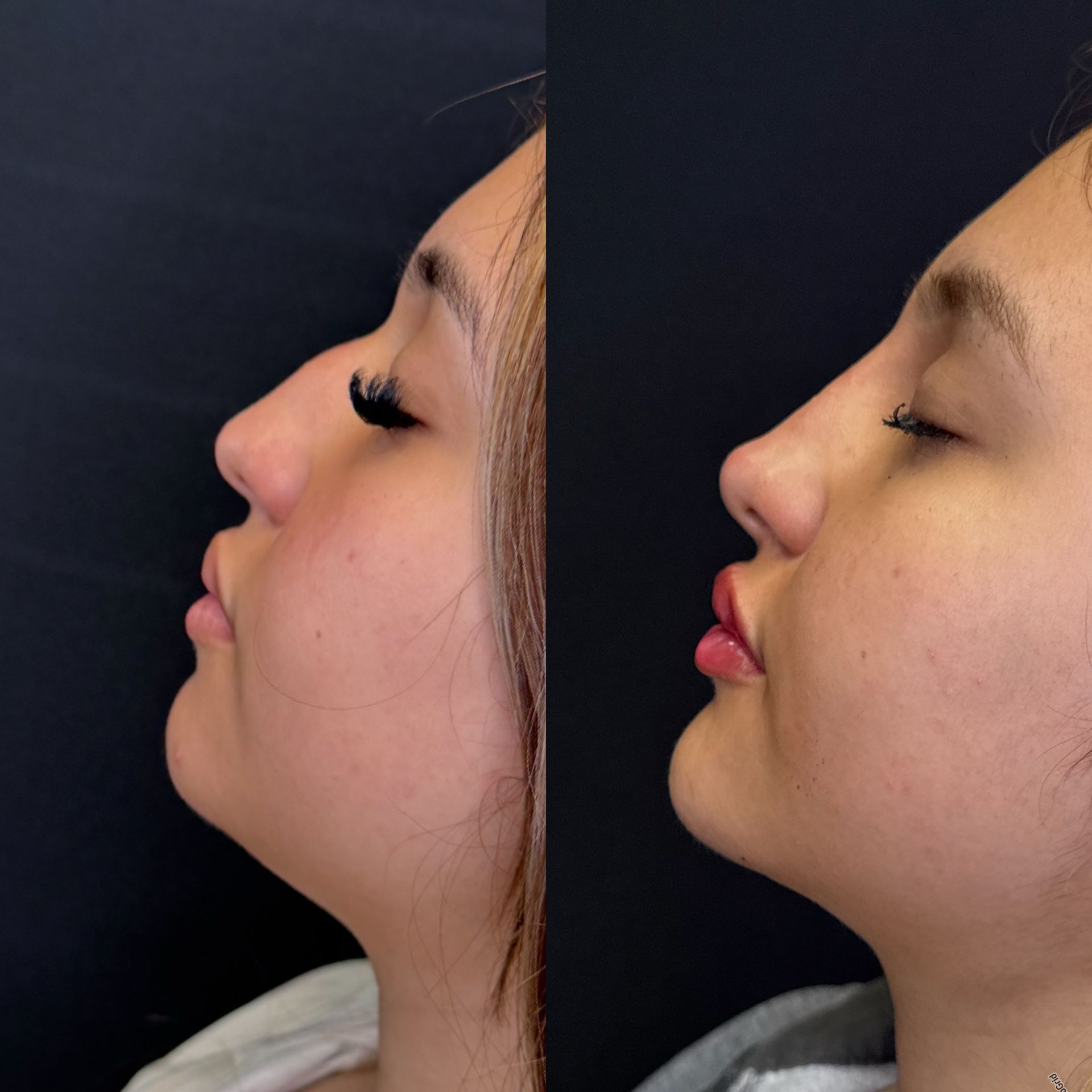 Side-by-side profile photos of a woman’s face, showing before-and-after chin and jawline changes.
