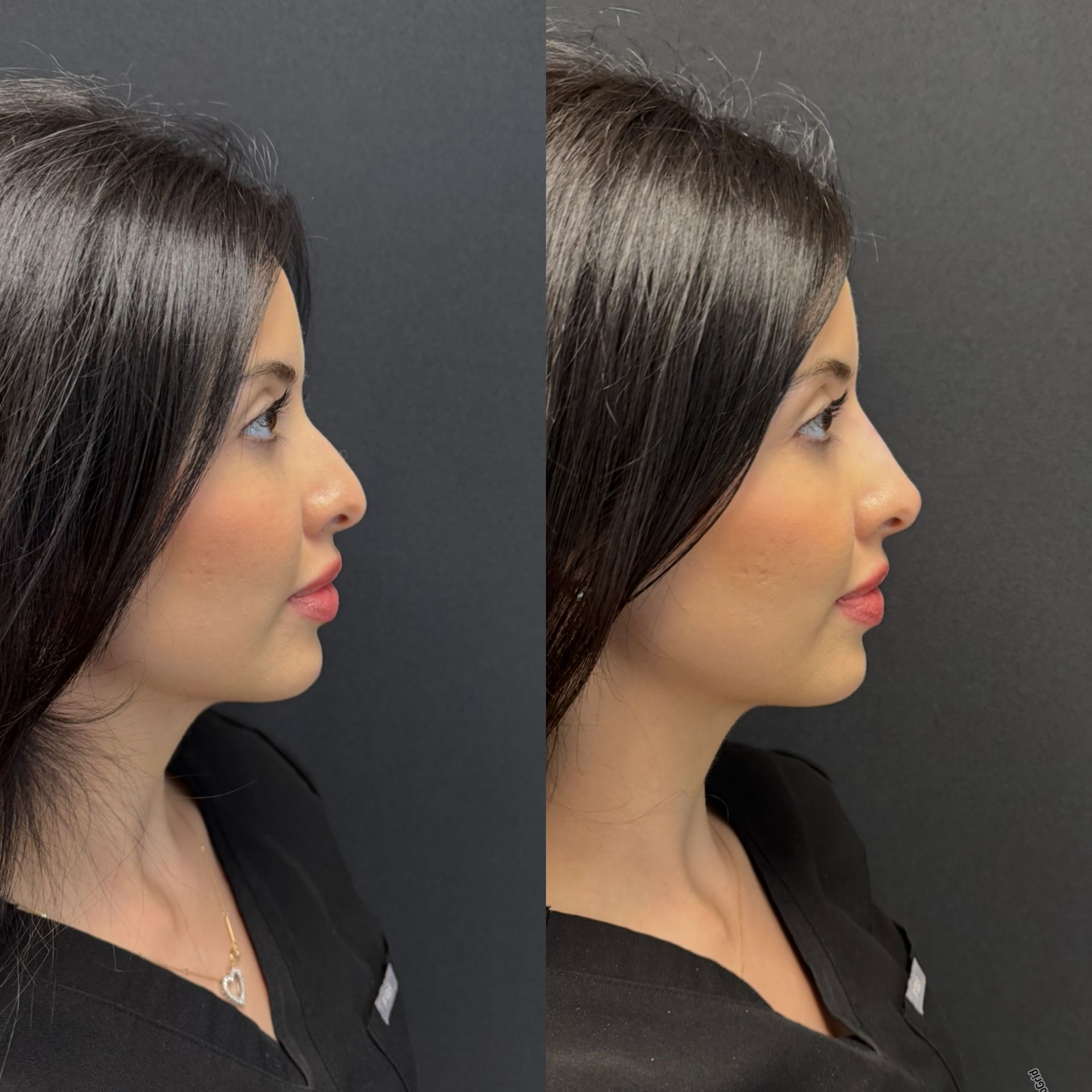 Side-by-side profile views of a woman with straight dark hair against a gray background