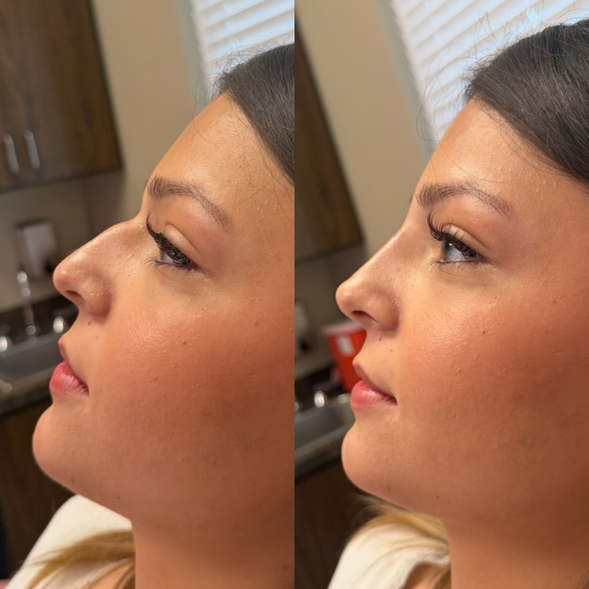 Side-by-side profile view of a woman’s face, showing before-and-after skin appearance.