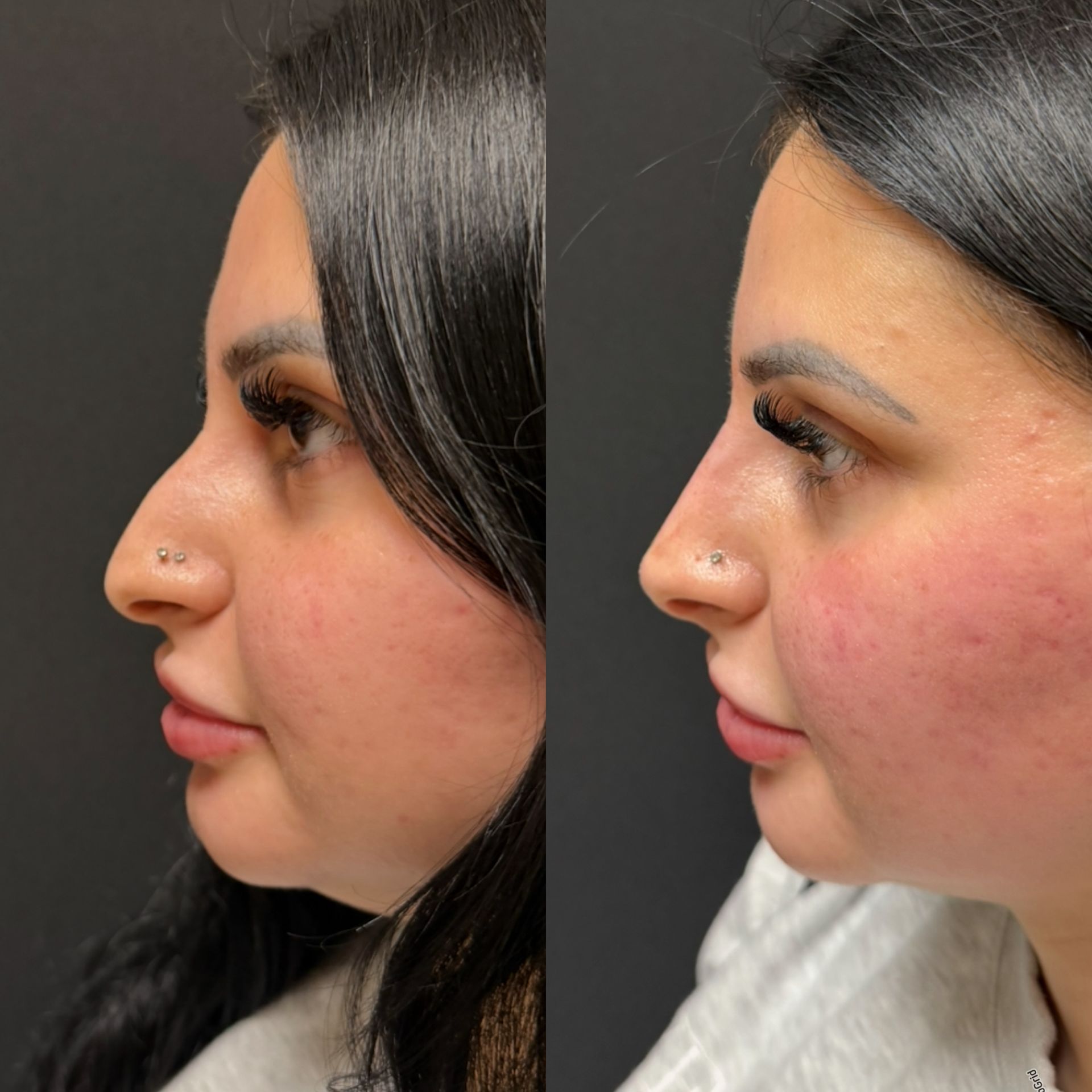 Side-by-side profile photos of a person with dark hair, showing before and after facial changes.