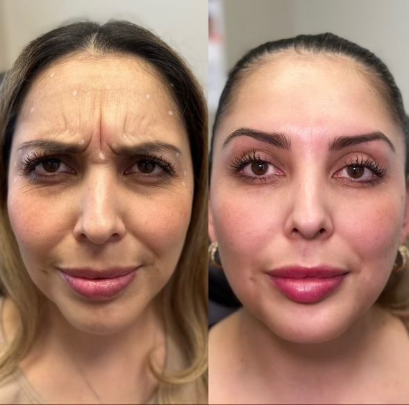Side-by-side close-up facial comparison: one woman before and after smoothing cosmetic treatment.